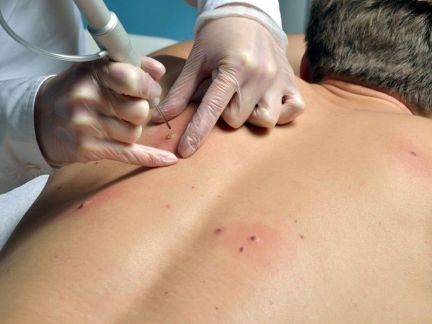 Удаление папиллом, бородавок, шипиц  Армавир