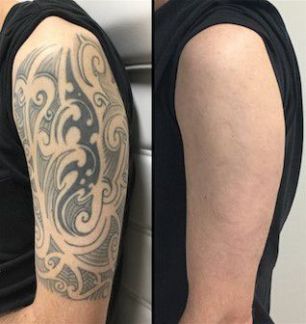 Удаление тату и перманентного макияжа  Армавир