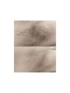 Мужская депиляция и стрижка тримером любых зон  Армавир