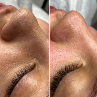 Чистка лица  Армавир