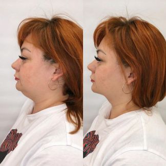 Smas лифтинг  Армавир